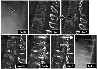 Internal replacement of a vertebral body in pseudarthrosis—Armed kyphoplasty with bone graft-filled stents: Case report